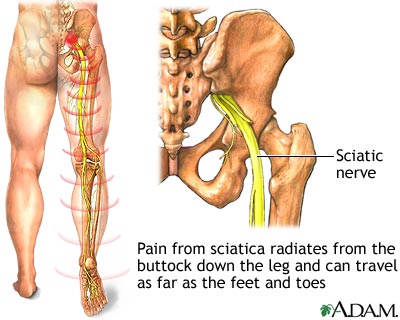 sciatic nerve back pain